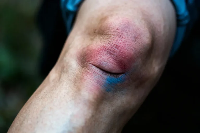 Genou avec ecchymose rouge et bleu. Peau légèrement enflée. Blessure récente à soigner.