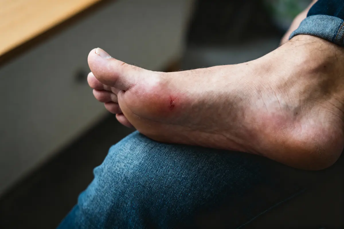 Pied avec une petite coupure sur le talon, repose sur un genou en jean.
