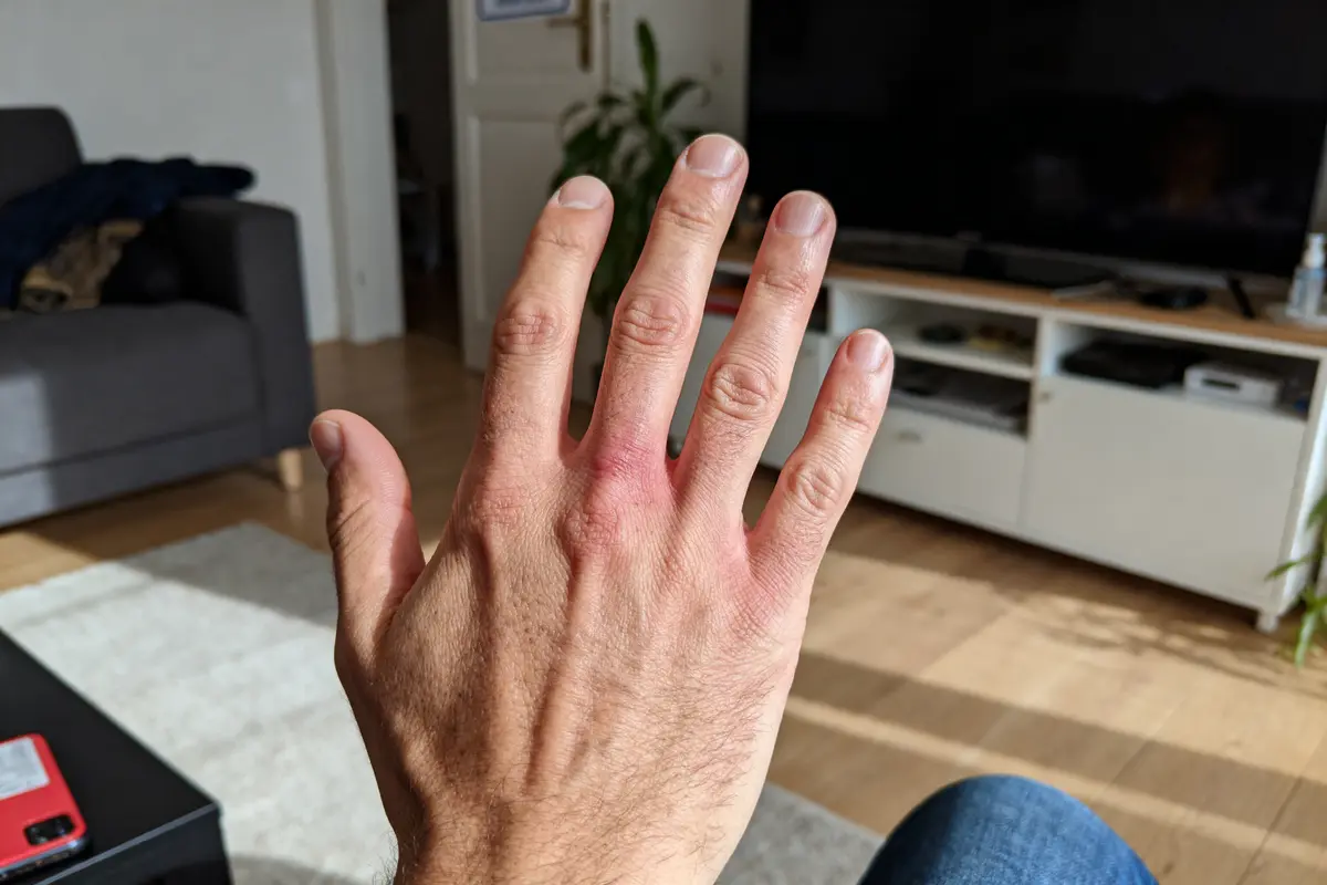 Main gauche avec rougeur et gonflement, fond salon moderne avec canapé, télévision et meuble.