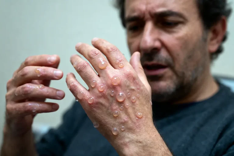 Homme regardant ses mains couvertes de cloques, semble préoccupé par une éruption cutanée sérieuse.