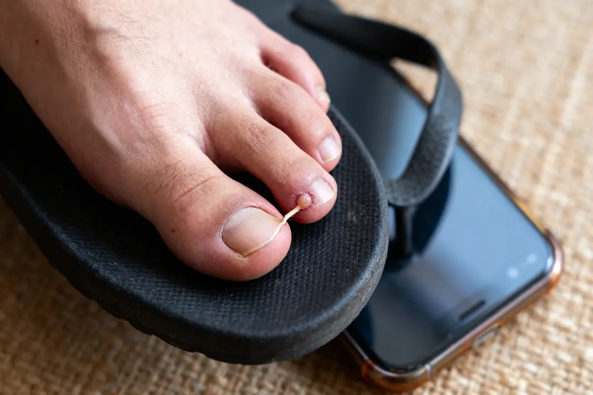 Un pied en sandale avec une écharde dans l'orteil, sur un téléphone portable, fond en tissu.