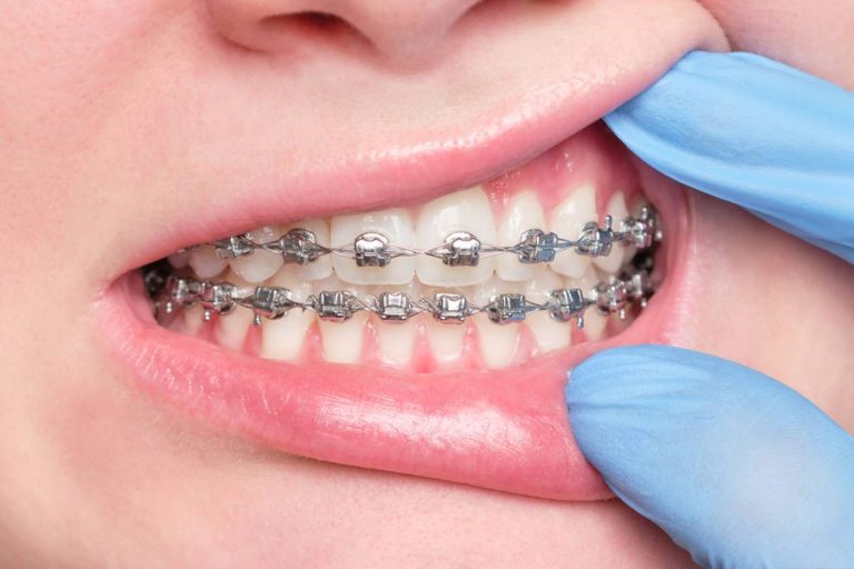 Consultation orthodontiste à Saint-Denis : ce qu&rsquo;elle change
