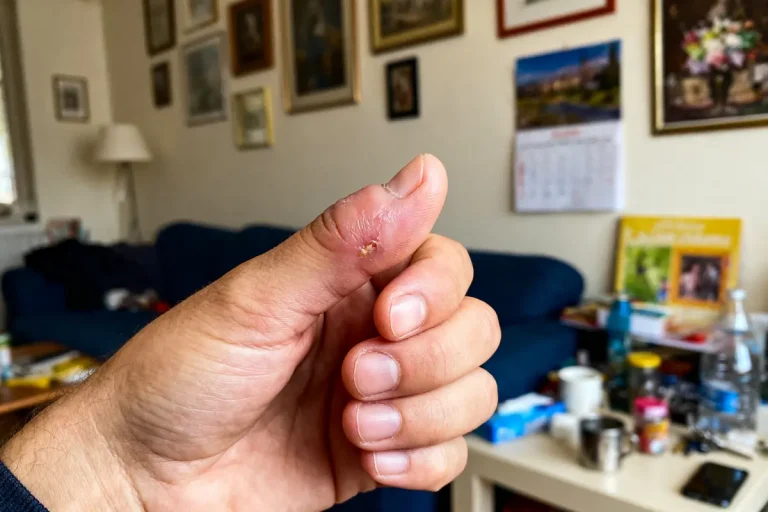 Gros plan sur un pouce abîmé, plaie visible, intérieur d'un salon décoré.