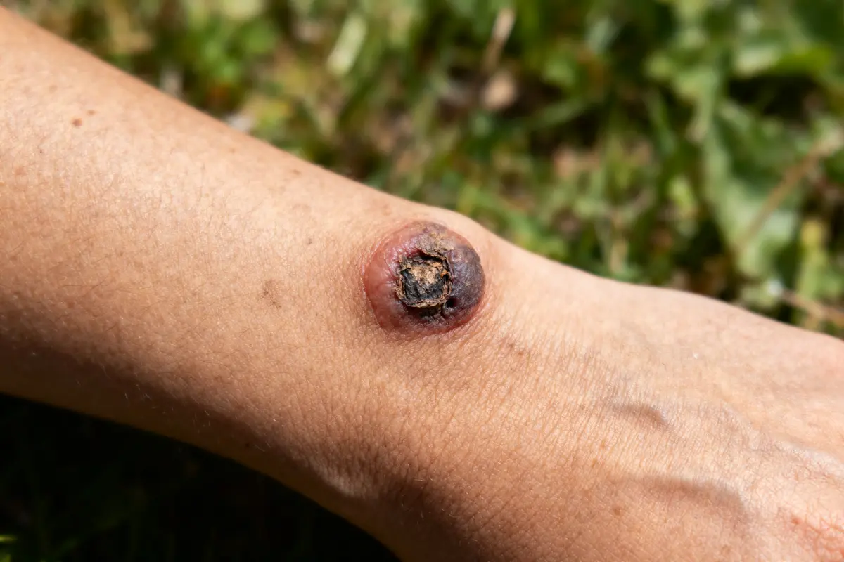 Plaie ronde et croûteuse sur peau humaine, entourée d'une légère inflammation. Herbe en arrière-plan flou.
